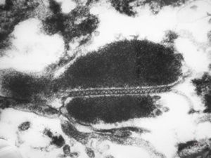M,76y. | septate junctions between degraded organelles - mesothelioma M,76y. | septate junctions between degraded organelles - mesothelioma